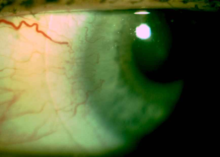Neovascularisation in Contact Lens overwear